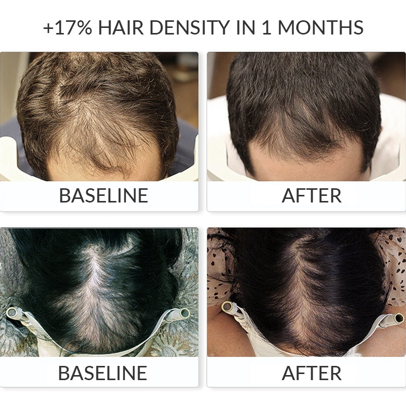 Spray QINGLIN pour la pousse des cheveux